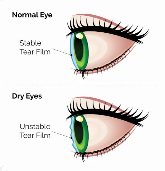 Unstable-tear-film