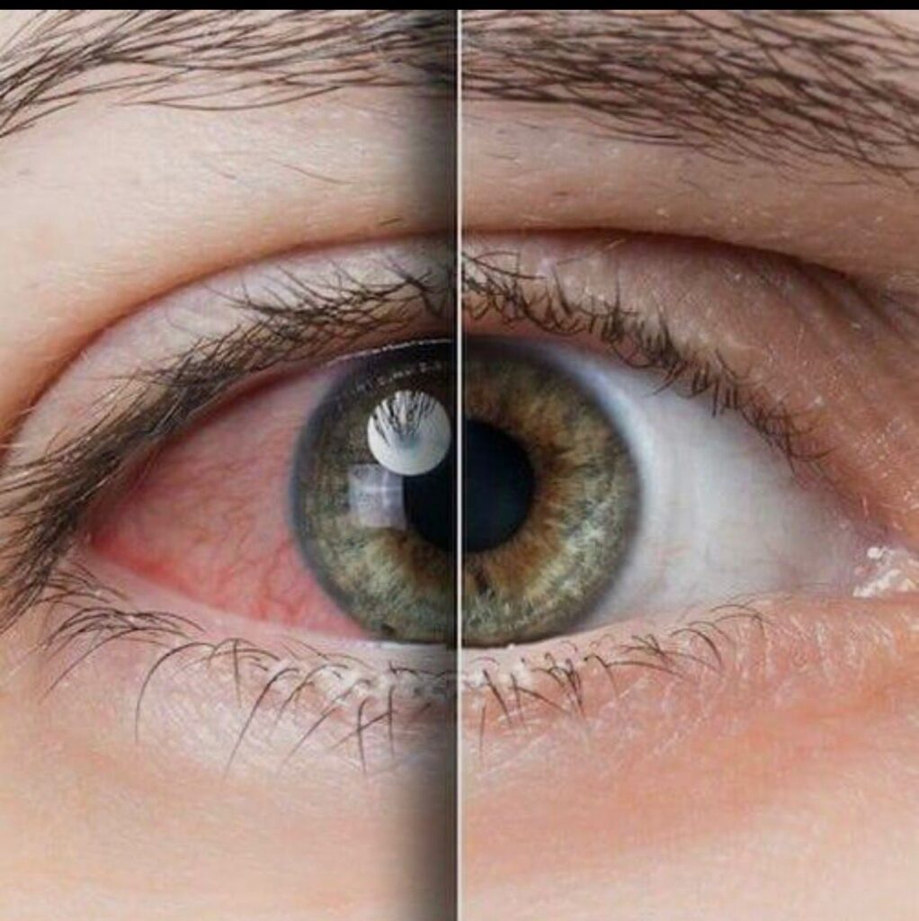dry-eyes-overview