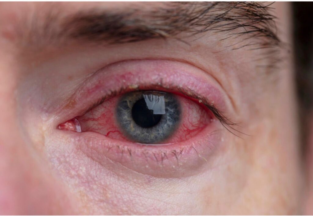 Eye Conditions